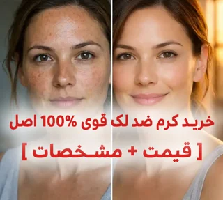 خرید کرم ضد لک قوی 100% اصل کاملا درمانی [ قیمت + مشخصات ]