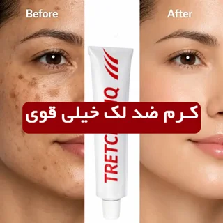 کرم ضد لک خیلی قوی HQ تریت‌سی – درمان لک‌های مقاوم و لک بعد از لیزر