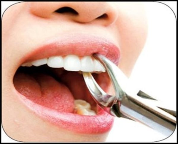 مراقبت بعد کشیدن دندان