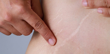 رفع ترک های پوستی,روش های موثر برای درمان ترک های پوستی,درمان های ترک های پوستی