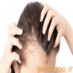 درمان ریزش مو و افزایش رشد موها با طب سوزنی