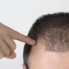 ریزش مو، 7 علت شایع و مهم ریزش مو از زبان یک متخصص پوست
