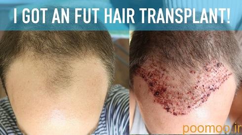 hair-transplant-FUT, کاشت مو FUT