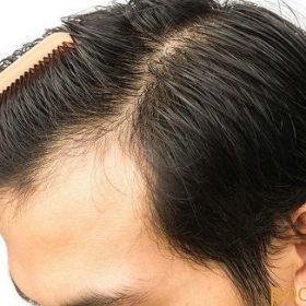کاشت مو به چه روش هایی انجام می شود؟+ انواع روش کاشت مو