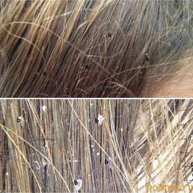 علایم ابتلا به شپش و سریع ترین روش درمان شپش موی سر