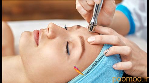 microdermabrasion,میکرودرم ابریژن