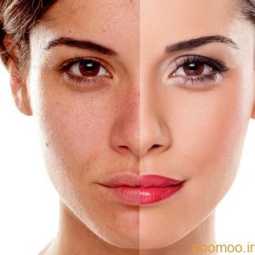 علت دو رنگ شدن پوست و لک شدن پوست چیست