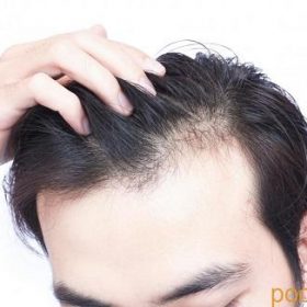 علت ریزش مو چیست زمانی که ژنتیک هیچ تقصیری ندارد؟