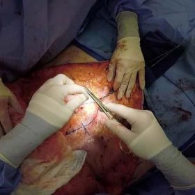 جراحی تامی تاک (شل شدگی شکم): همه نکاتی که باید بدانید