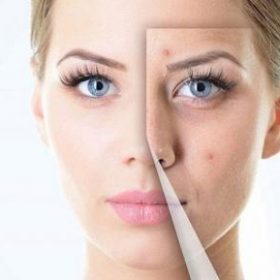 درمان جوش و رفع لکه های پوستی با 2 ماسک کاربردی خانگی