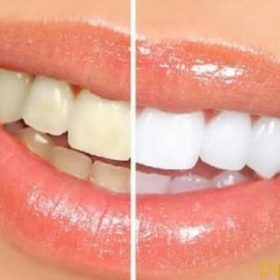 سفید کردن دندان با یک روش موثر و بدون ضرر!!