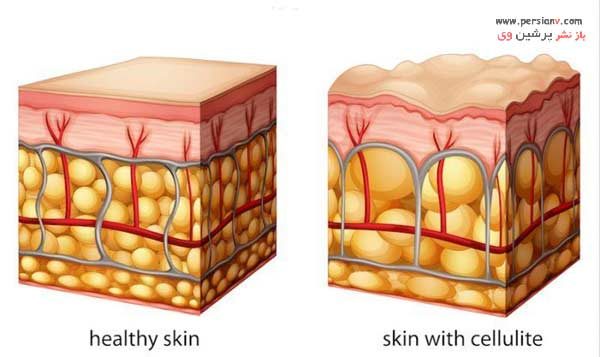 درمان قطعی سلولیت
