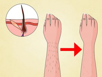 حذف کامل موهای زائد بدن با لیزر 