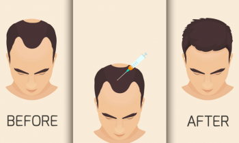 سلول های بنیادی برای درمان ریزش مو