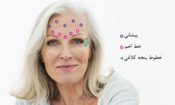 نقاط تزریق بوتاکس