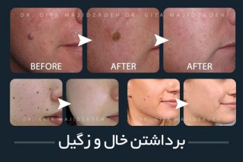 قبل و بعد از رادیوفرکانسی