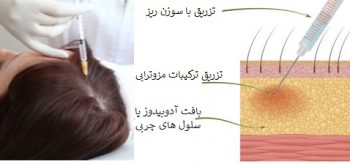 درمان مزوتراپی مو