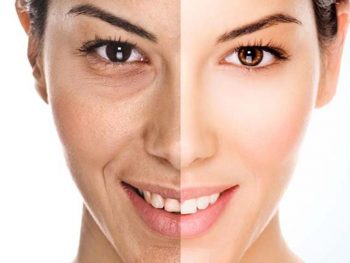 مزوتراپی صورت