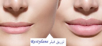 نمونه فیلر Restylane - انواع فیلر های لب