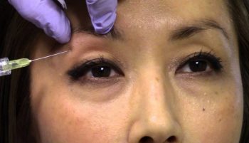 تزریق ژل پشت پلک