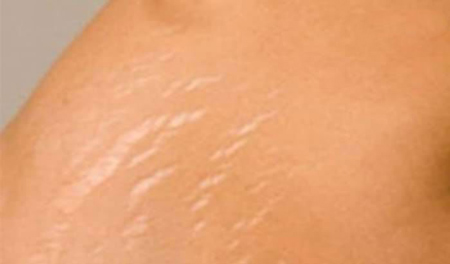 رفع ترک های پوستی,روش های موثر برای درمان ترک های پوستی,درمان های ترک های پوستی
