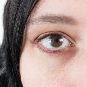طبیعی‌ترین درمان برای سیاهی دور چشم